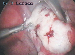 Surface red endometriosis of the ovary (laparoscopic image).